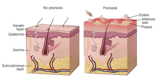 Zdravá kůže a kůže postižená psoriázou